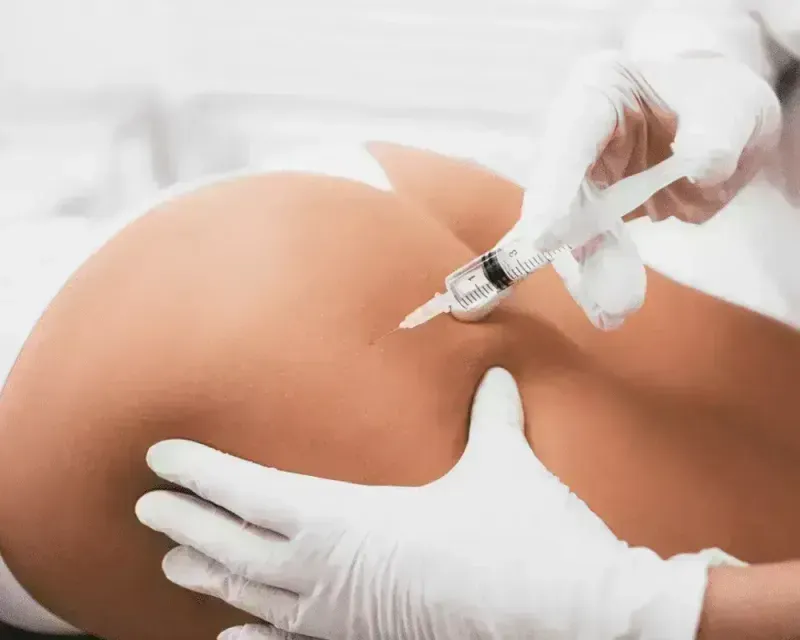 Read more about the article How to Achieve a Lifted and Toned Butt: Hyaluronic Dermal Fillers