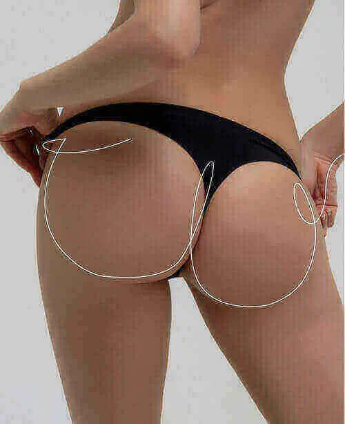Buttocks Augmentation Add volume and lift gluteal area