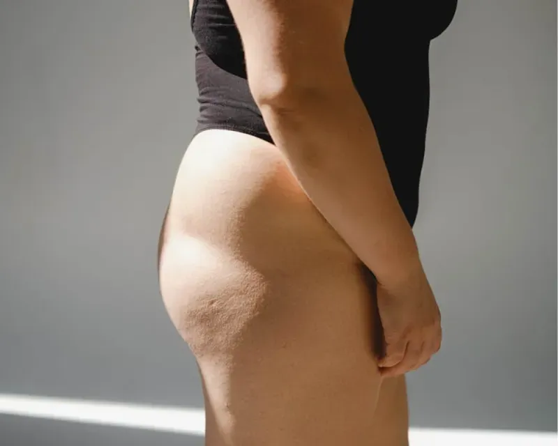 Buttock Enhancement Procedure: Why Hyaluronic Acid Fillers are Gaining Popularity?