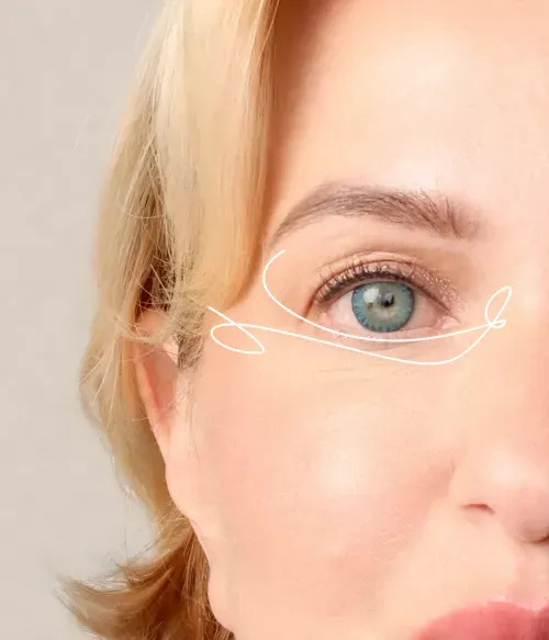 Treatment of Periorbital Lines Reduce the Appearance of Wrinkles Around Eyes