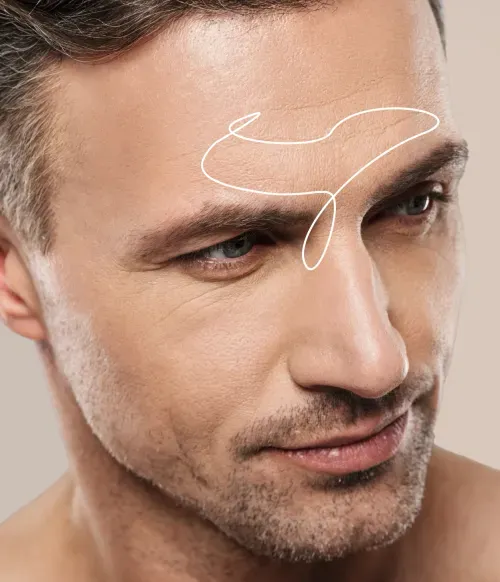 Treatment of Glabellar Wrinkles Reduces The Appearance Of Medium To Deep Folds In The Glabella Region