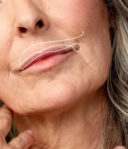 Treatment of the Perioral Area Treats the Superficial to Medium Wrinkles in the Perioral Region