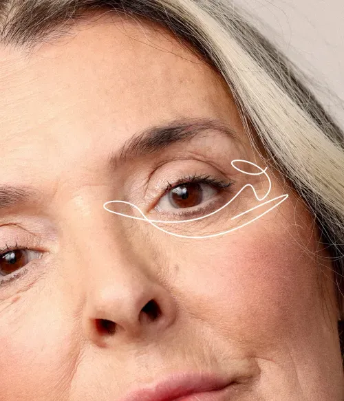 Rejuvenation of Periorbital Area Reduces The Appearance Of Superficial to Medium Wrinkles In The Periorbital Region