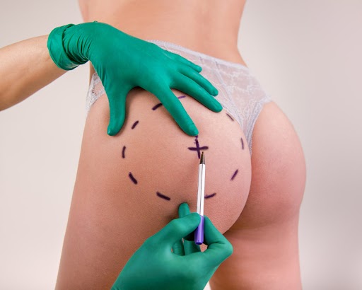 From Loose to Luscious: Dermal Fillers For Butt Lift After Weight Loss August 26, 2024 For many of us, losing stubborn weight is a great accomplishment, especially if you’ve been struggling with it for long! But in this constant tussle, we forget to focus on our skin. Sunken facial features, loose skin around the waist, thighs, and buttocks are very common after a drastic weight loss. Dermal fillers are one of the best solutions to restore your skin laxity and lost volume.